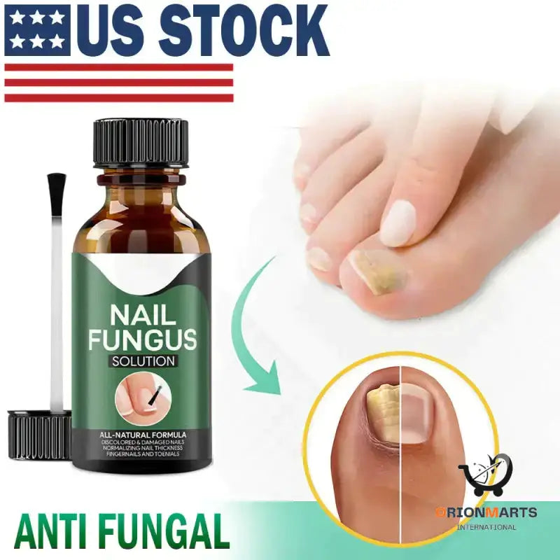 Anti-Fungal Nail Treatment